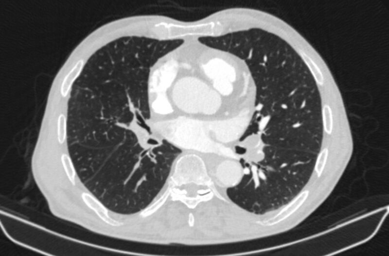 File:Chronic pulmonary embolism (Radiopaedia 91241-108843 Axial lung window 50).jpg