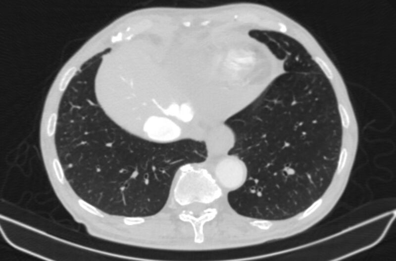 File:Chronic pulmonary embolism (Radiopaedia 91241-108843 Axial lung window 75).jpg