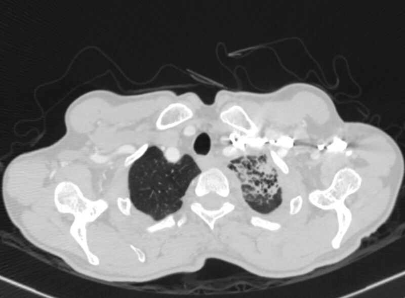 File:Chronic pulmonary embolism with bubbly consolidation (Radiopaedia 91248-108850 Axial lung window 9).jpg