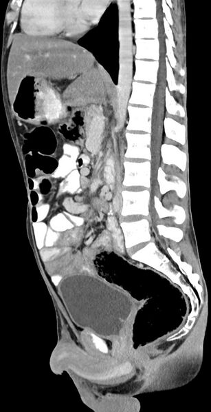 File:Chronic small bowel volvulus (Radiopaedia 75224-86322 C 75).jpg