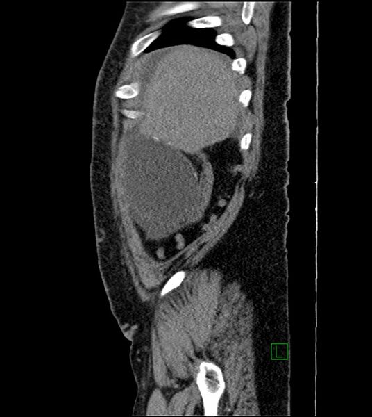 File:Closed-loop small bowel obstruction-internal hernia (Radiopaedia 78439-91096 C 124).jpg