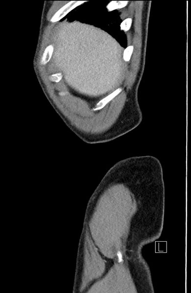 File:Closed loop small bowel obstruction - internal hernia (Radiopaedia 57806-64778 C 106).jpg