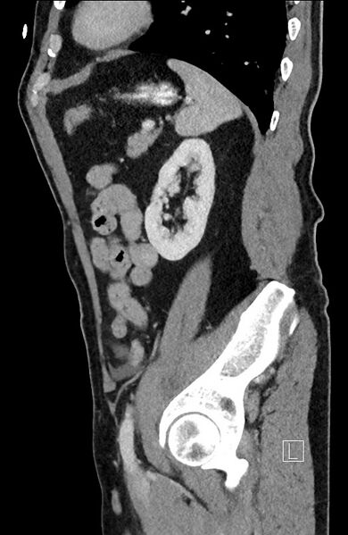 File:Closed loop small bowel obstruction - internal hernia (Radiopaedia 57806-64778 C 33).jpg