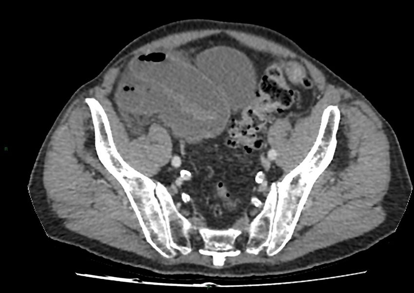 Closed loop small bowel obstruction with ischemia (Radiopaedia 84180-99456 A 95).jpg