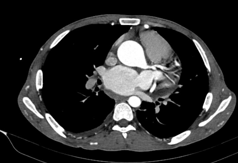 File:Coarctation of aorta with aortic valve stenosis (Radiopaedia 70463-80574 A 103).jpg