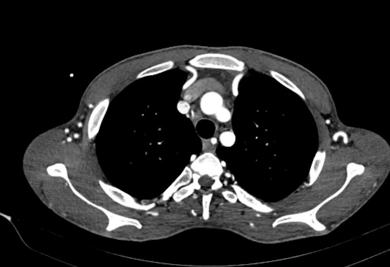File:Coarctation of aorta with aortic valve stenosis (Radiopaedia 70463-80574 A 24).jpg