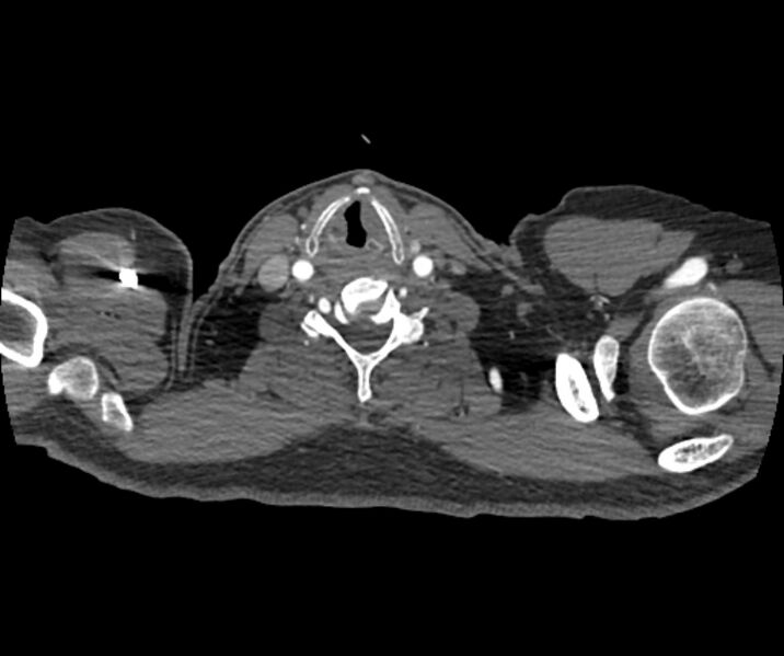 File:Coarctation of the aorta (Radiopaedia 53752-59822 A 4).jpg