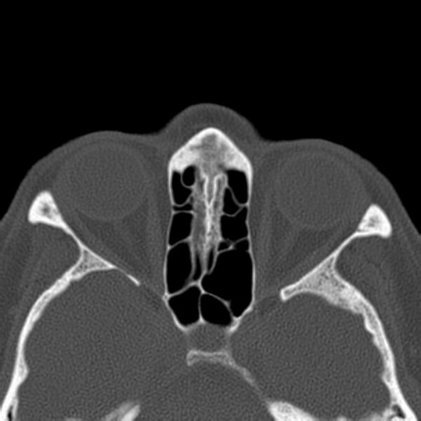 File:Nasolabial cyst (Radiopaedia 33987-35205 Axial bone window 32).jpg