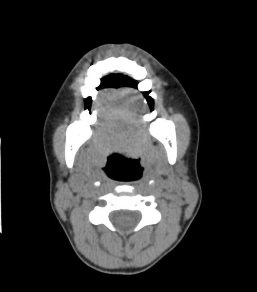 File:Nasoorbitoethmoid fracture (Radiopaedia 90044-107205 Axial non-contrast 75).jpg