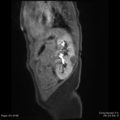 Nephroblastomatosis (Radiopaedia 39984-42478 C 1).png