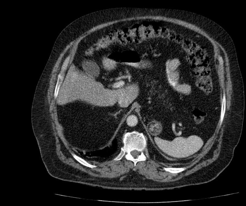 Nephroptosis with inguinal hernia containing perirenal fat (Radiopaedia 56632-63391 C 96).jpg