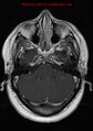 Neuroglial cyst (Radiopaedia 10713-11184 Axial T1 C+ 18).jpg