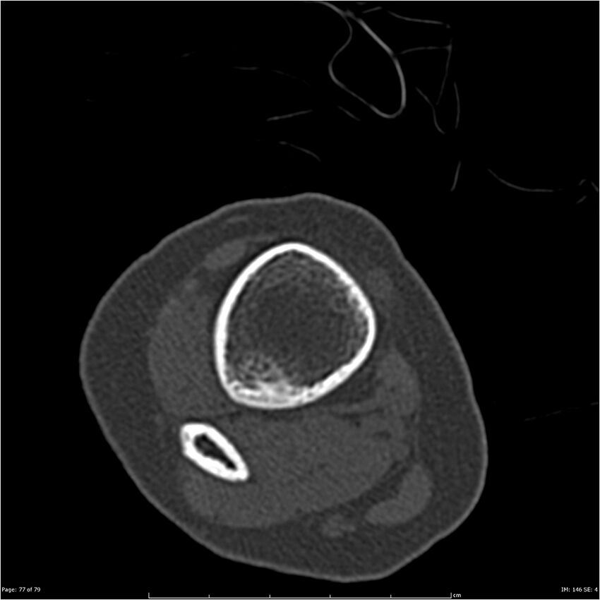 Non-ossifying fibroma (Radiopaedia 23651-23780 bone window 77).jpg