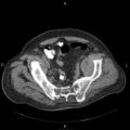 Non Hodgkin lymphoma in a patient with ankylosing spondylitis (Radiopaedia 84323-99624 Axial non-contrast 57).jpg