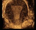 Normal 3D uterus (Radiopaedia 34301-35588 B 1).jpg