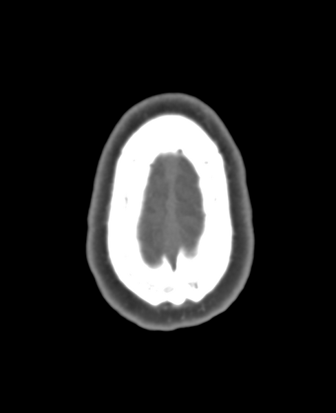 File:Normal CTA head (Radiopaedia 40801-43464 A 11).png
