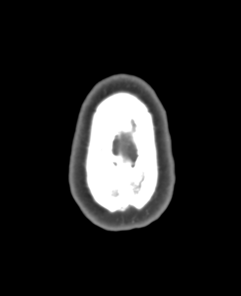 File:Normal CTA head (Radiopaedia 40801-43464 A 9).png