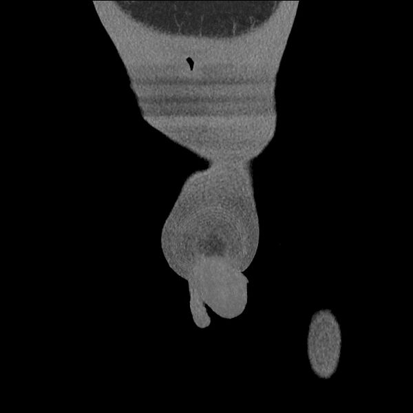 File:Normal CT angiogram of pelvis (Radiopaedia 45390-49430 B 7).jpg