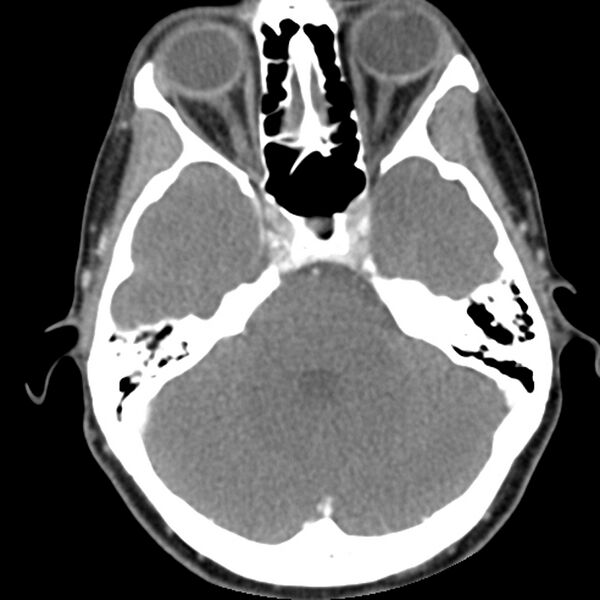 File:Normal CT of the neck (Radiopaedia 14575-14500 Axial C+ 7).jpg