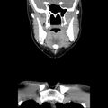 Normal CT of the neck (Radiopaedia 14575-14500 Coronal C+ 19).jpg