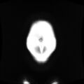 Normal MRI abdomen in pregnancy (Radiopaedia 88001-104541 Coronal T2 3).jpg