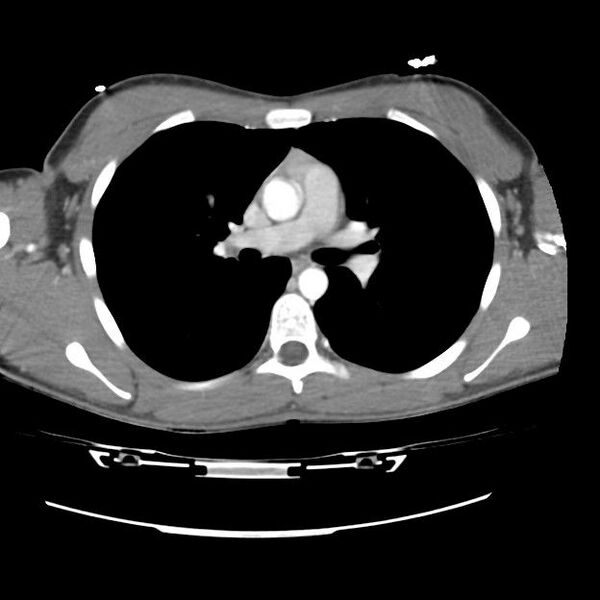 File:Normal dual-phase trauma CT chest,abdomen and pelvis (Radiopaedia 48092-52899 A 24).jpg