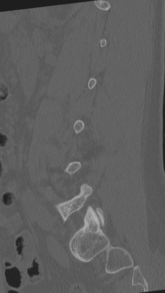 File:Normal lumbar spine CT (Radiopaedia 46533-50986 Sagittal bone window 34).png