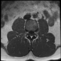 Normal lumbar spine MRI (Radiopaedia 35543-37039 Axial T1 26).png