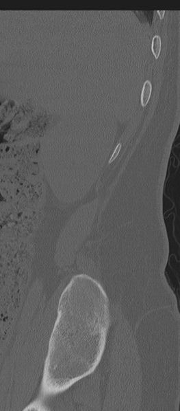 File:Normal lumbosacral CT (Radiopaedia 37923-39867 Sagittal bone window 95).png