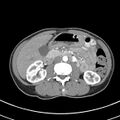 Normal multiphase CT liver (Radiopaedia 38026-39996 B 40).jpg