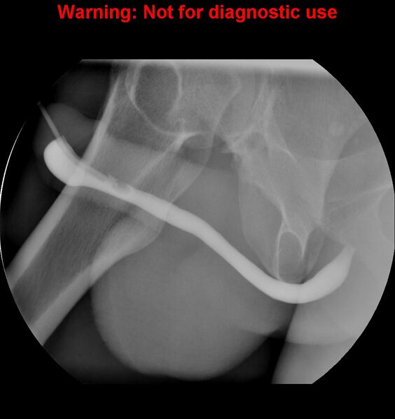 File:Normal retrograde urethrogram (RUG) and voiding cystourethrogram (VCUG) (Radiopaedia 40478-43050 RUG 4).jpg