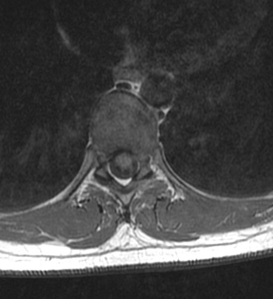 File:Normal thoracic spine MRI (Radiopaedia 41033-43781 Axial T1 8).jpg