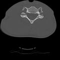 Normal trauma spine imaging (age 16) (Radiopaedia 45335-49358 Axial bone window 55).jpg