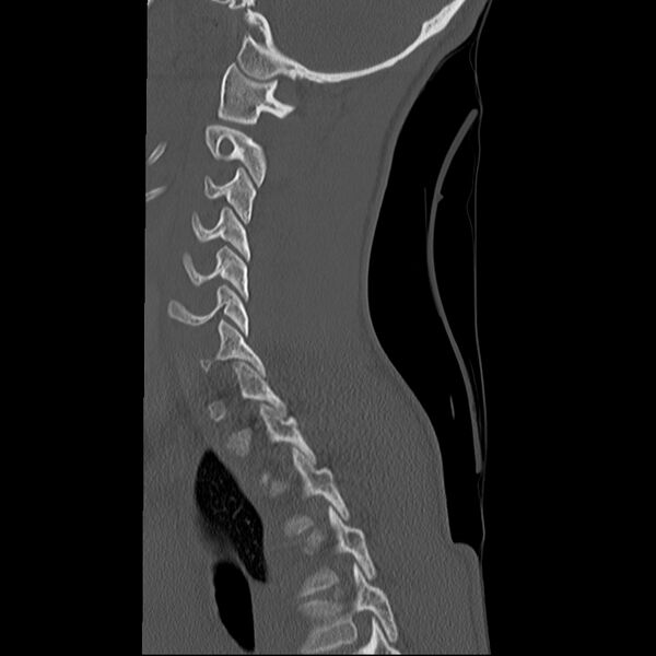 File:Normal trauma spine imaging (age 16) (Radiopaedia 45335-49358 Sagittal bone window 10).jpg