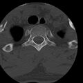 Occipital condyle fracture (Radiopaedia 31755-32691 Axial bone window 85).jpg