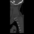 Occipital condyle fracture (Radiopaedia 31755-32691 Sagittal bone window 39).jpg