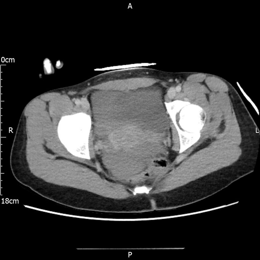 AAST grade IV kidney injury with CEUS follow-up (Radiopaedia 72353-82877 Axial C+ portal venous phase 72).jpg