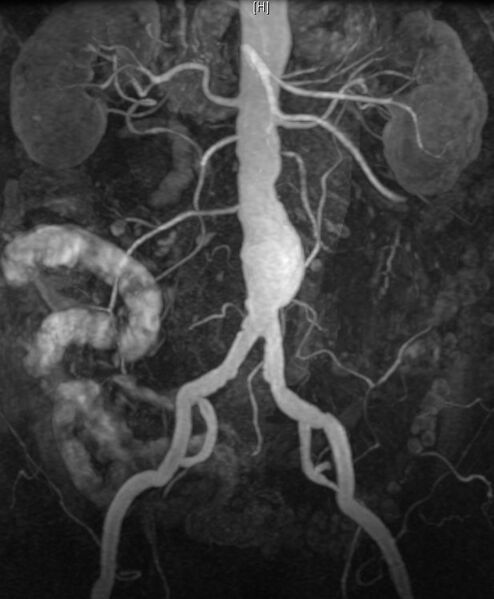 File:Abdominal aortic aneurysm (Radiopaedia 14317-14210 Coronal Contrasted MRA (MIP) 1).jpg