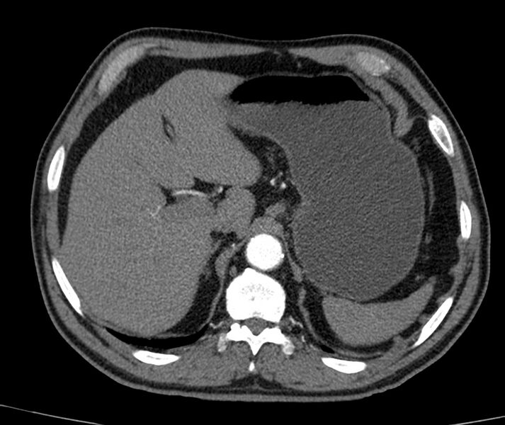 File:Abdominal aortic aneurysm (Radiopaedia 22421-22458 C+ arterial phase 5).jpg