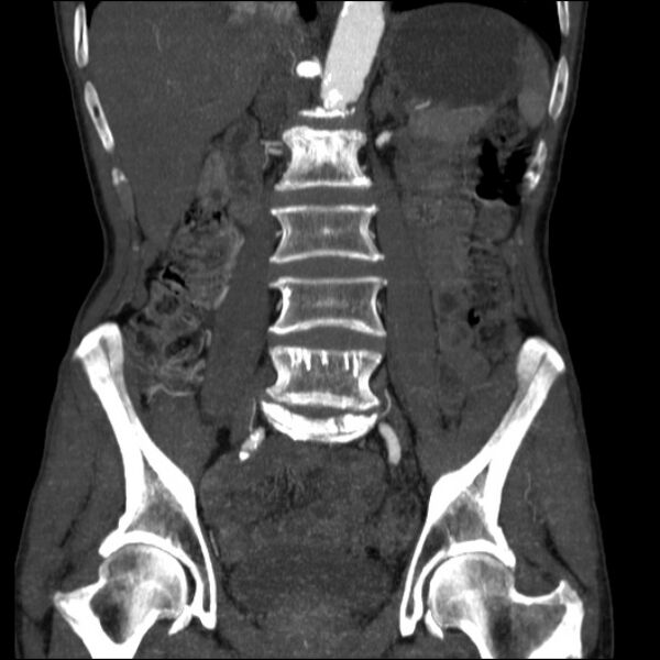 File:Abdominal aortic aneurysm (Radiopaedia 23703-23856 Coronal C+ arterial phase 17).jpg