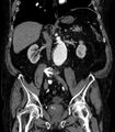 Abdominal aortic aneurysm (Radiopaedia 25855-26001 Coronal C+ arterial phase 38).jpg
