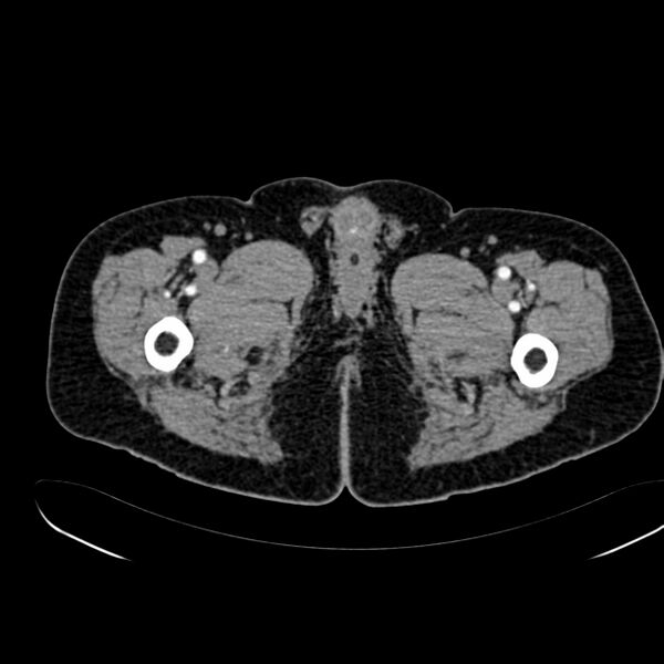 File:Abdominal aortic aneurysm (Radiopaedia 75131-86203 Axial C+ arterial phase 54).jpg