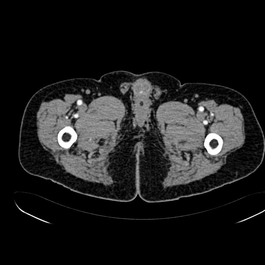Abdominal aortic aneurysm (Radiopaedia 75131-86203 Axial C+ arterial phase 54).jpg