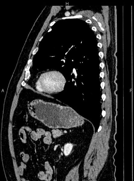 File:Abdominal aortic aneurysm (Radiopaedia 83094-97462 Sagittal renal cortical phase 86).jpg