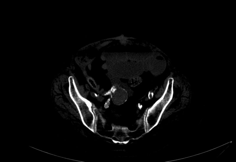 File:Abdominal aortic aneurysm - impending rupture (Radiopaedia 19233-19246 B 50).jpg