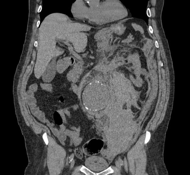 File:Abdominal aortic aneurysm rupture (Radiopaedia 11149-11514 B 1).jpg