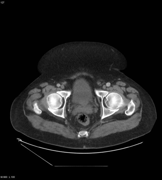 File:Abdominal aortic aneurysm with intramural hematoma then rupture (Radiopaedia 50278-55631 Axial C+ arterial phase 118).jpg