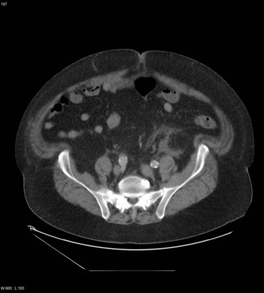 File:Abdominal aortic aneurysm with intramural hematoma then rupture (Radiopaedia 50278-55631 Axial C+ arterial phase 98).jpg