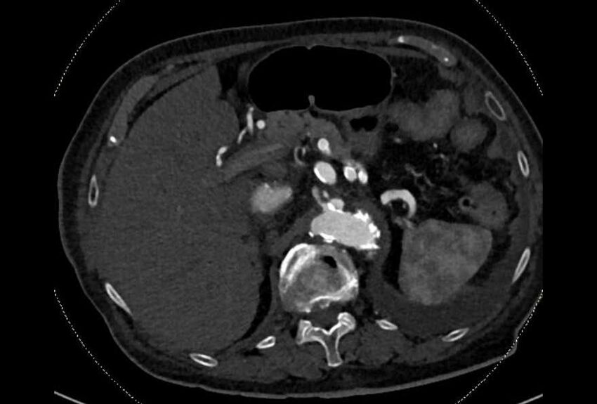 Abdominal aortic aneurysm with thrombus fissuration (Radiopaedia 73192-83919 Axial C+ arterial phase 30).jpg