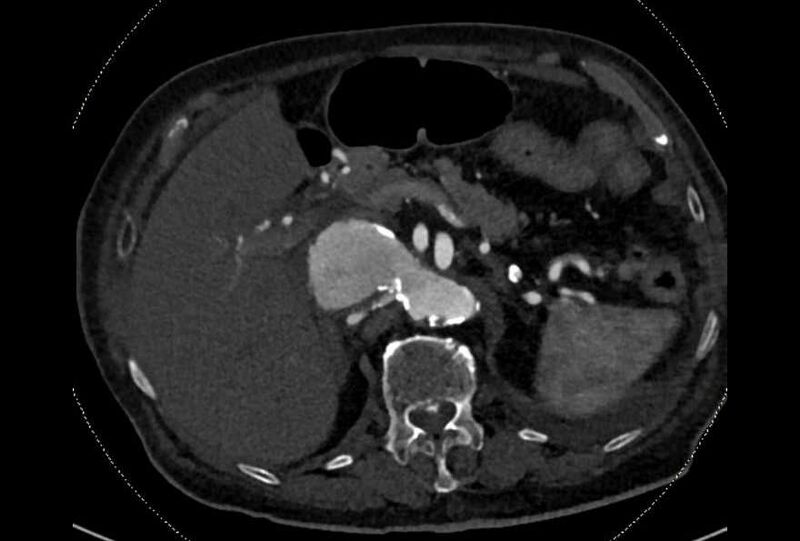 File:Abdominal aortic aneurysm with thrombus fissuration (Radiopaedia 73192-83919 Axial C+ arterial phase 35).jpg